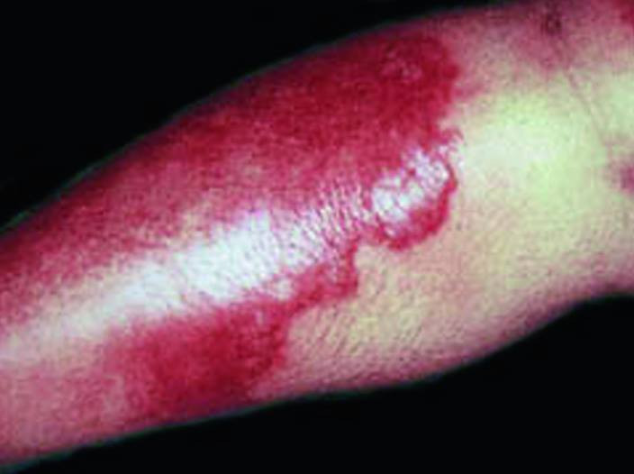 Erisipelas