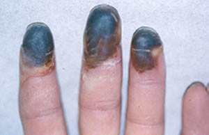 Penyakit Buerger (Tromboangitis Obliterans)