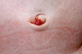 Granuloma Umbilikal