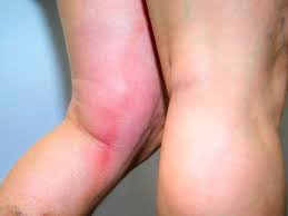 Tromboflebitis Pada Anak