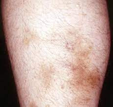 Poliarteritis Nodosa