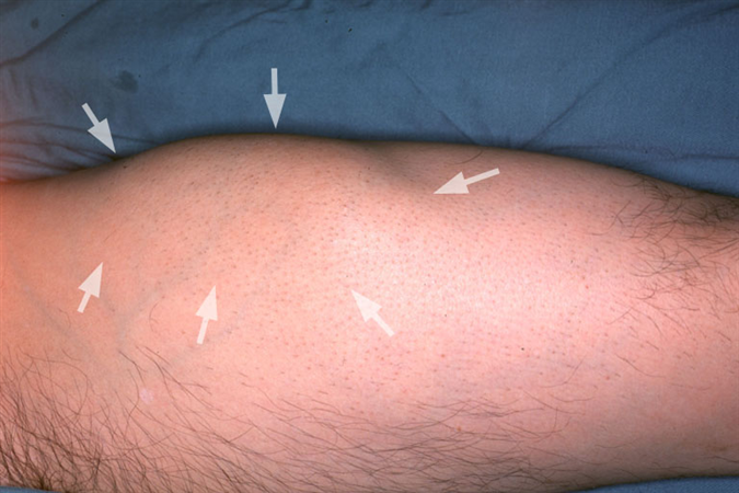 Tumor Jaringan Lunak (Soft Tissue Tumor)