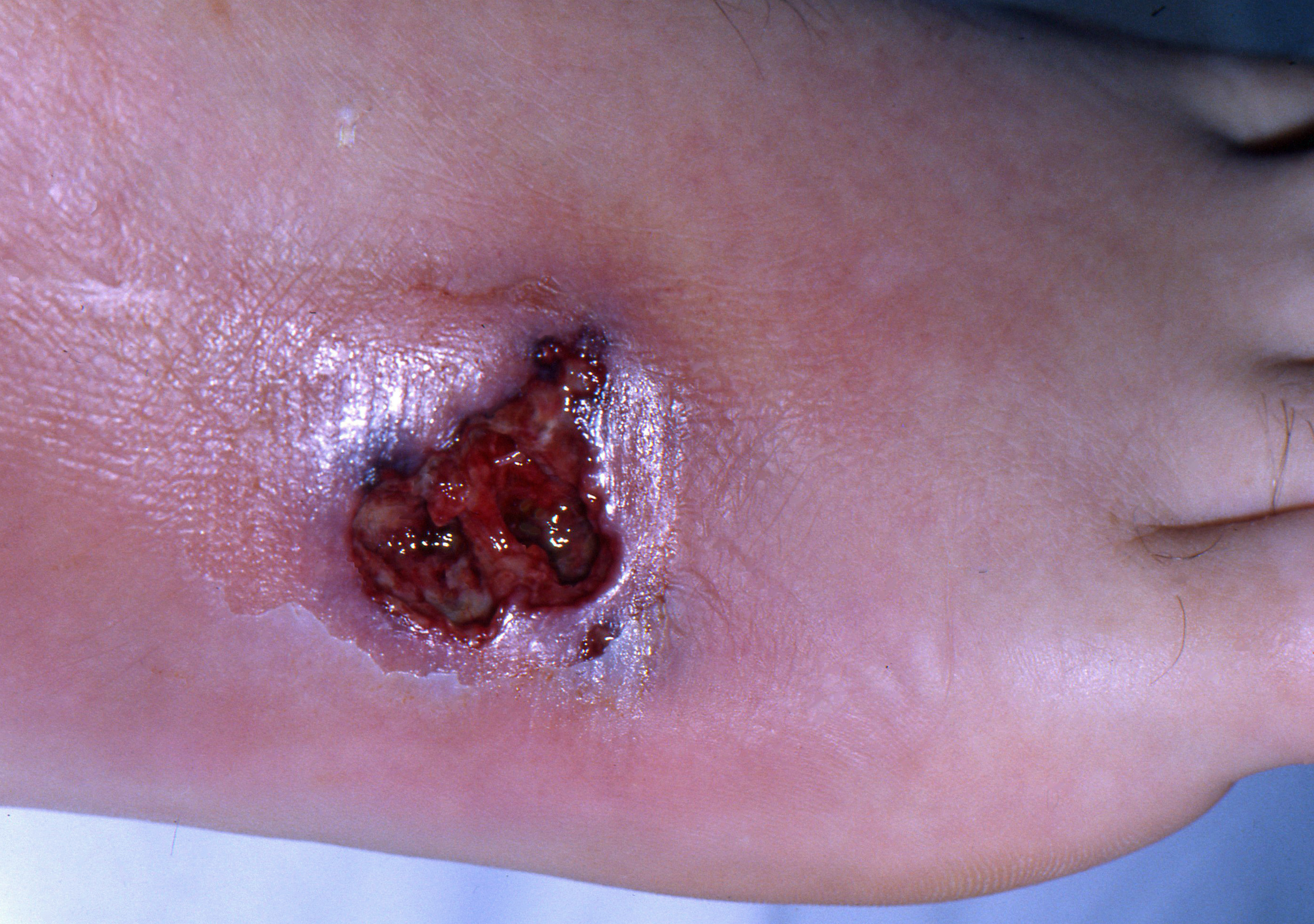 Pyoderma Gangrenosum (Ulkus Piogenik)