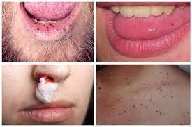 Telangiektasia Hemoragik Herediter (Sindrom Rendu-Oslor-Weber)