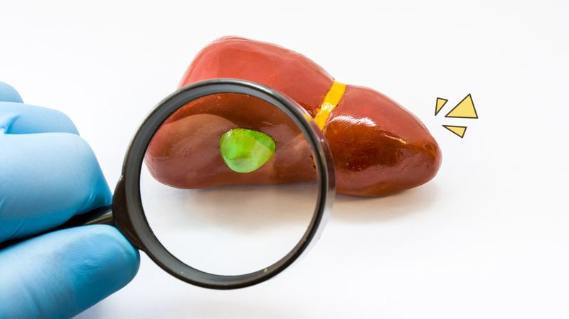 Karsinoma Kandung Empedu