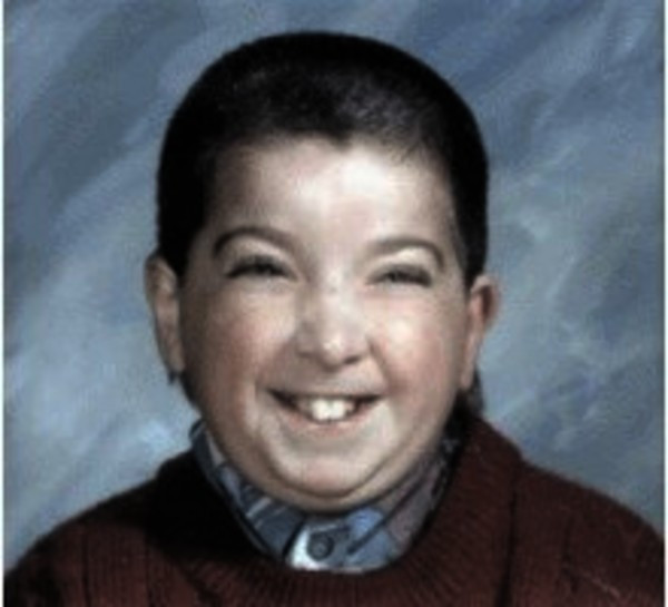 Sindrom Rubinstein-Taybi