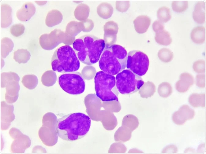 Leukemia Akut