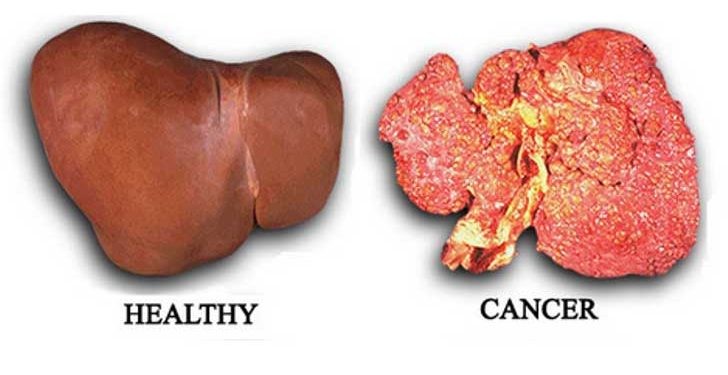 Kanker Hepatoselular