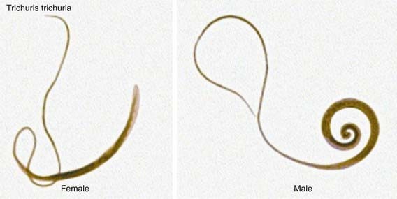 Trichuriasis