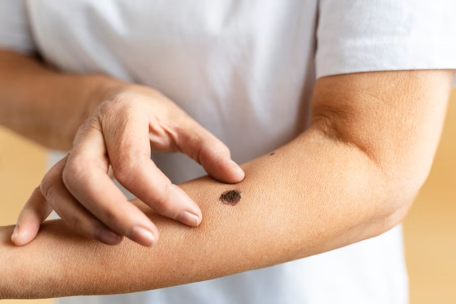 Penyebab dan Faktor Risiko Kanker Kulit