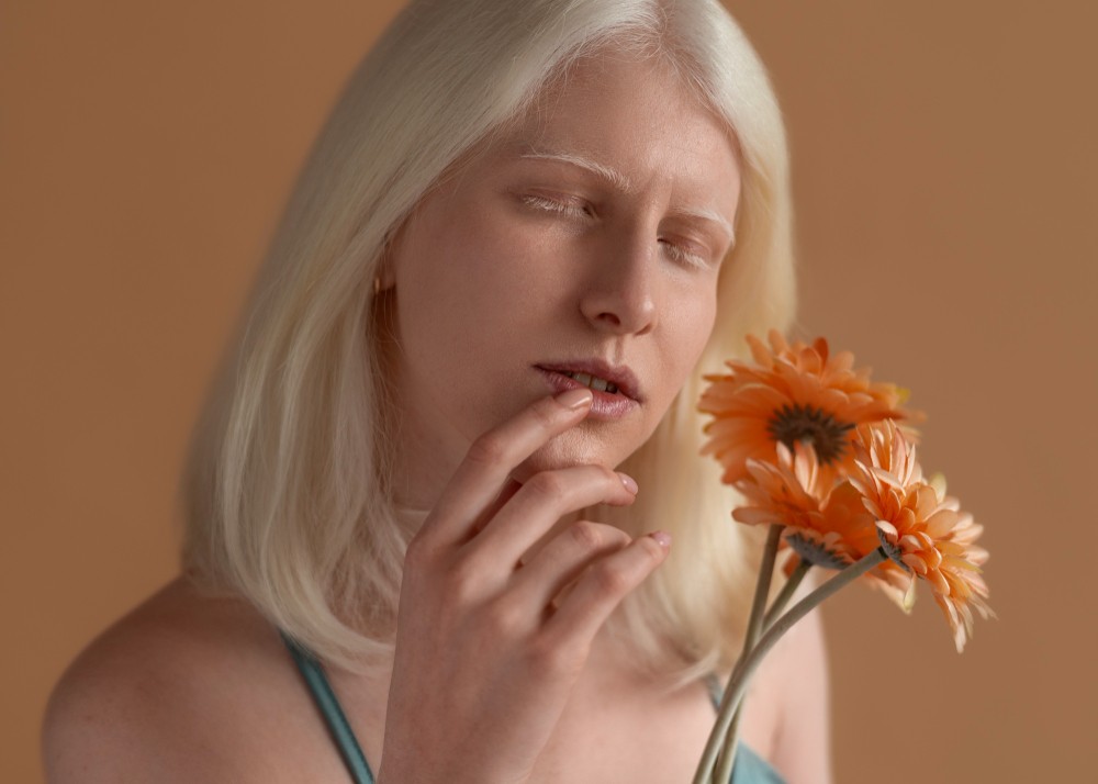 Mengenal Albinisme: Penyebab, Gejala, dan Penanganannya