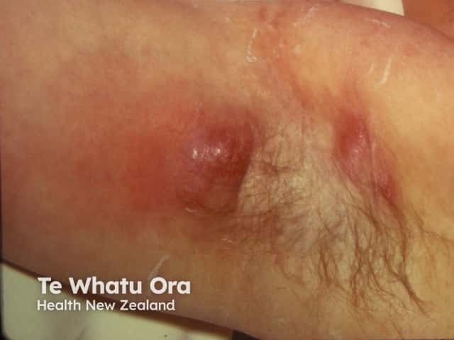 Gambar 1: Abses Credit: Dermnetnz.org